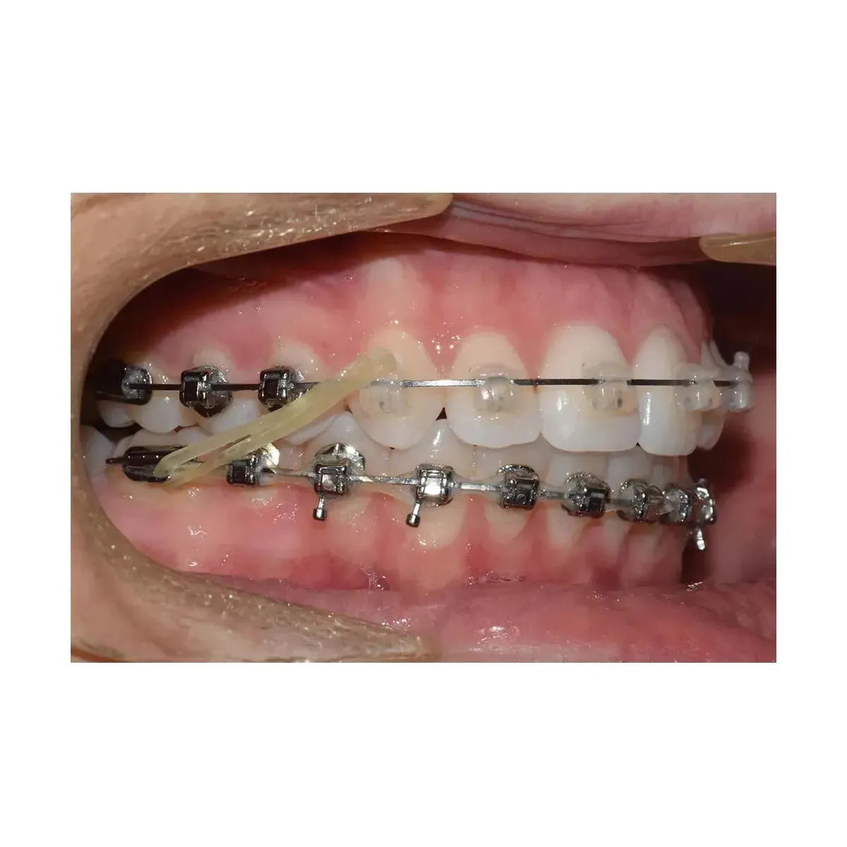 U Ortho Intraoral Elastics ( Pack Of 100 )