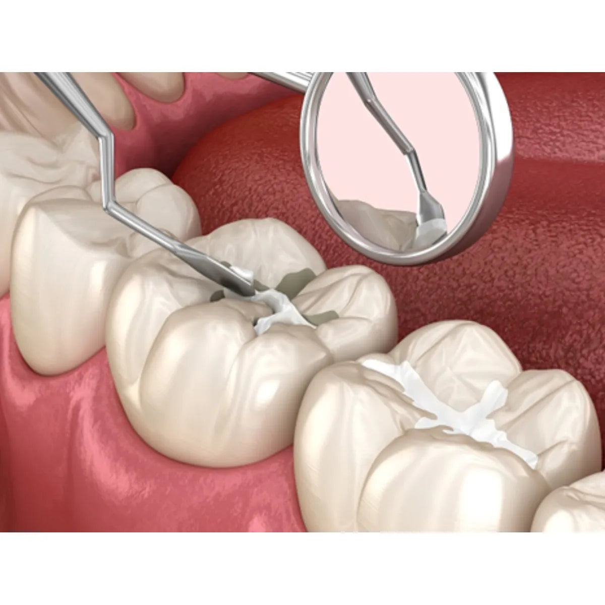 Prime Dental Prime Cem Ceramic Reinforced Glass Ionomer Cement