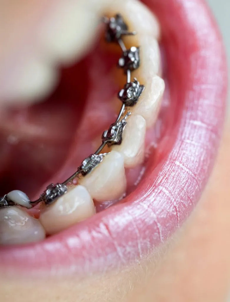 U Ortho Lingual Brackets 018
