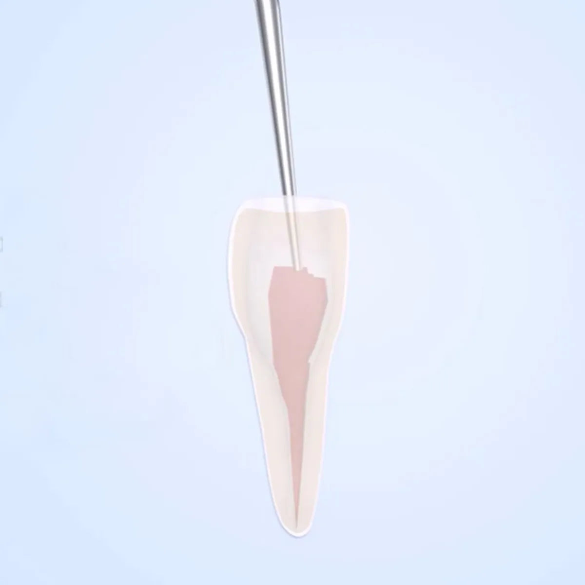 Woodpecker Scaler Tip ED3 for DTE & Satelec Scalers