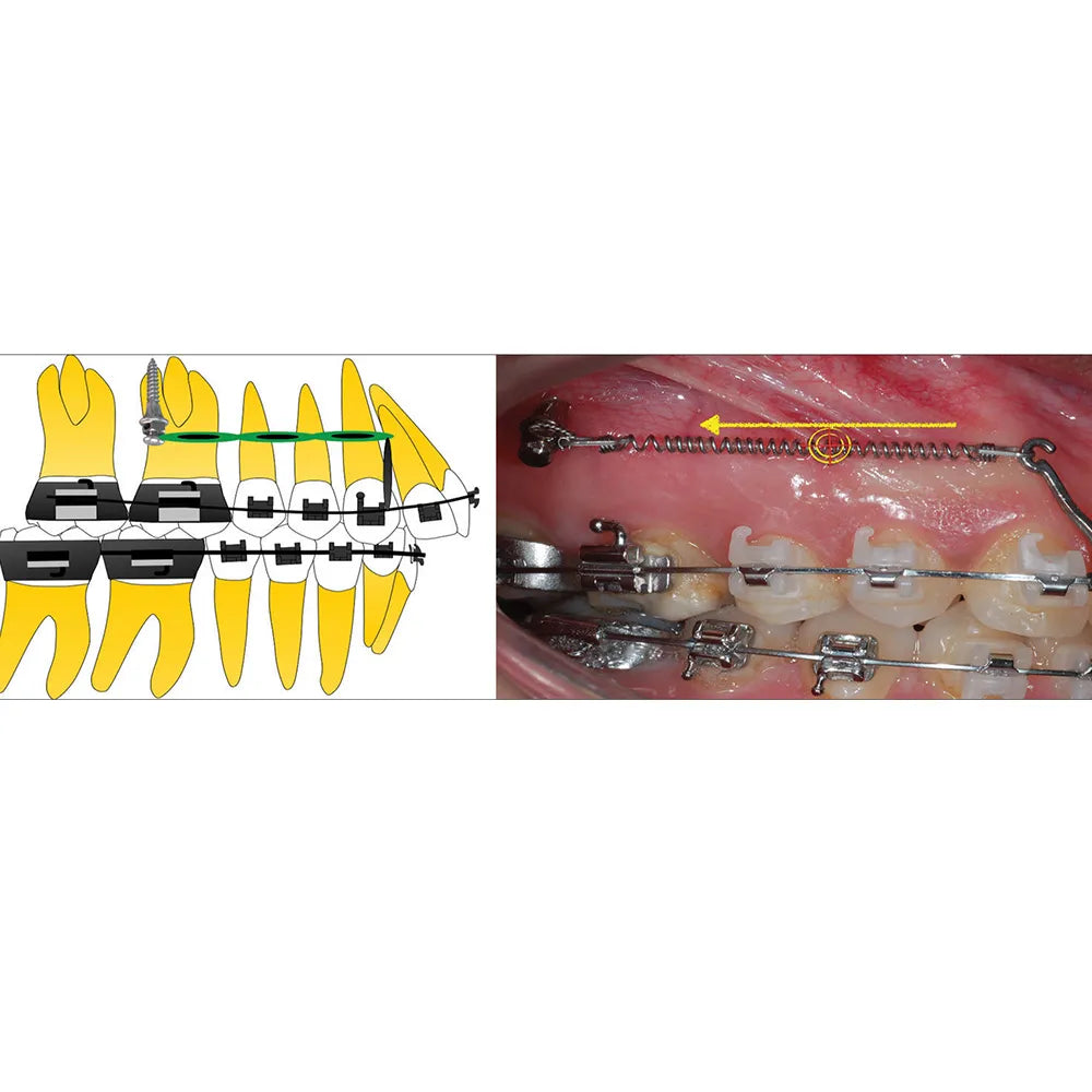 UU Ortho Titanium Mini Implant