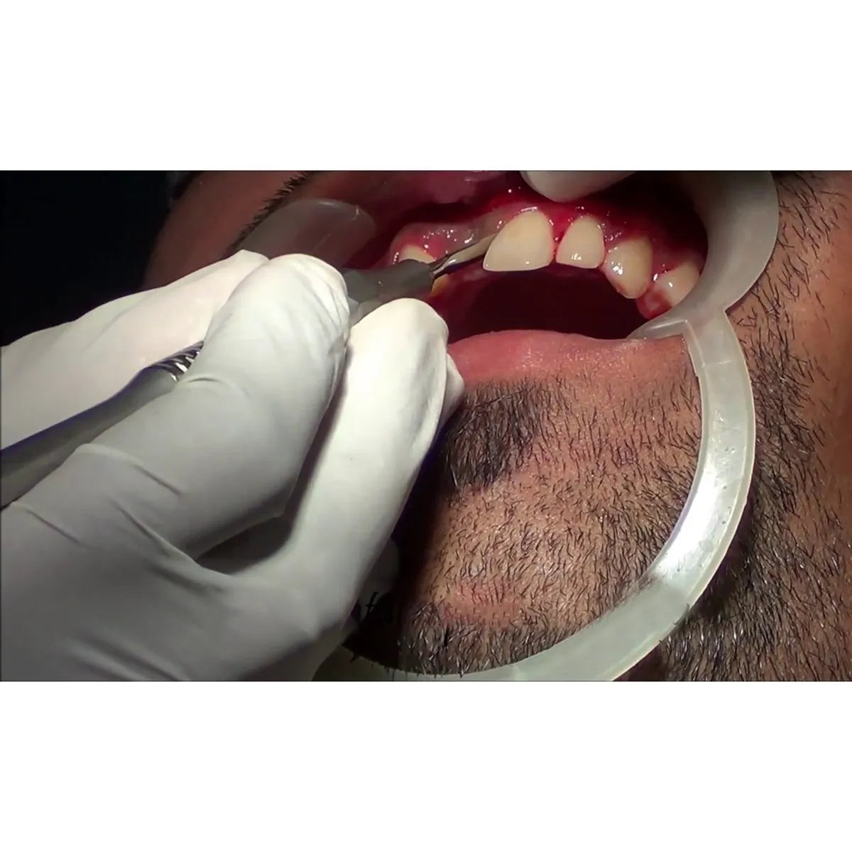 GDC Periotome # 4 (P3)