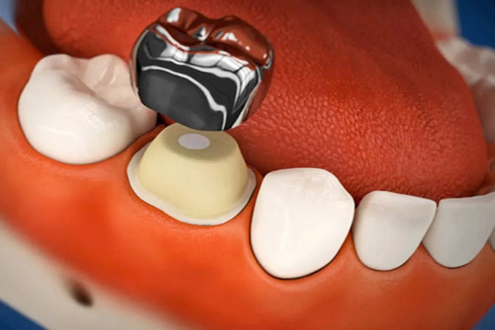 3M Espe SS Crown Primary Molar Crown-D (1st molar)