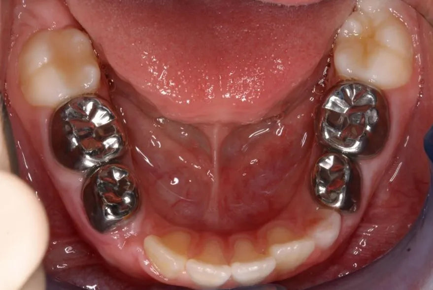 3M Espe SS Crown Primary Molar Crown-D (1st molar)