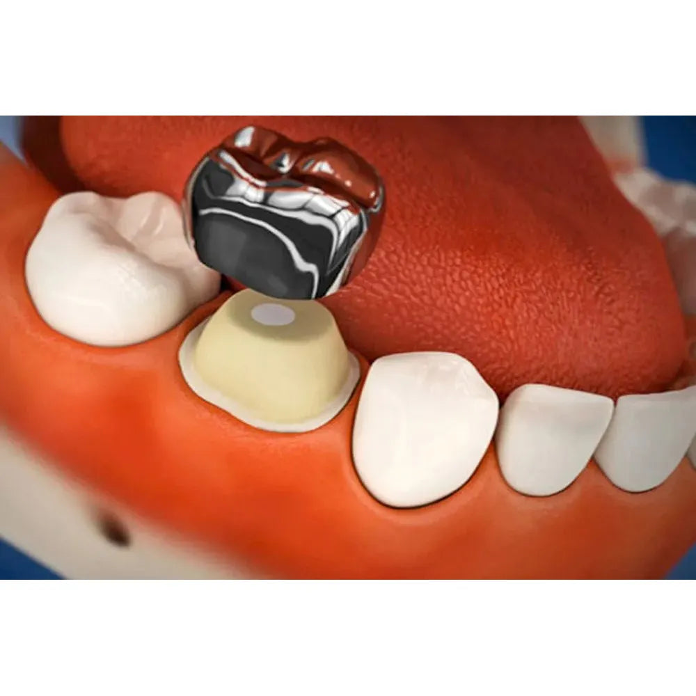 3M ESPE Stainless Steel Permanent 1st Molar Crown (Set Of 5)