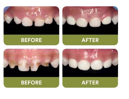 3M Paedodontic Zirconia Crowns Kits