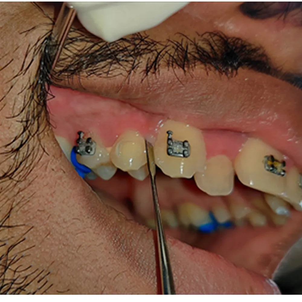 GDC Periotome #4 (P1)