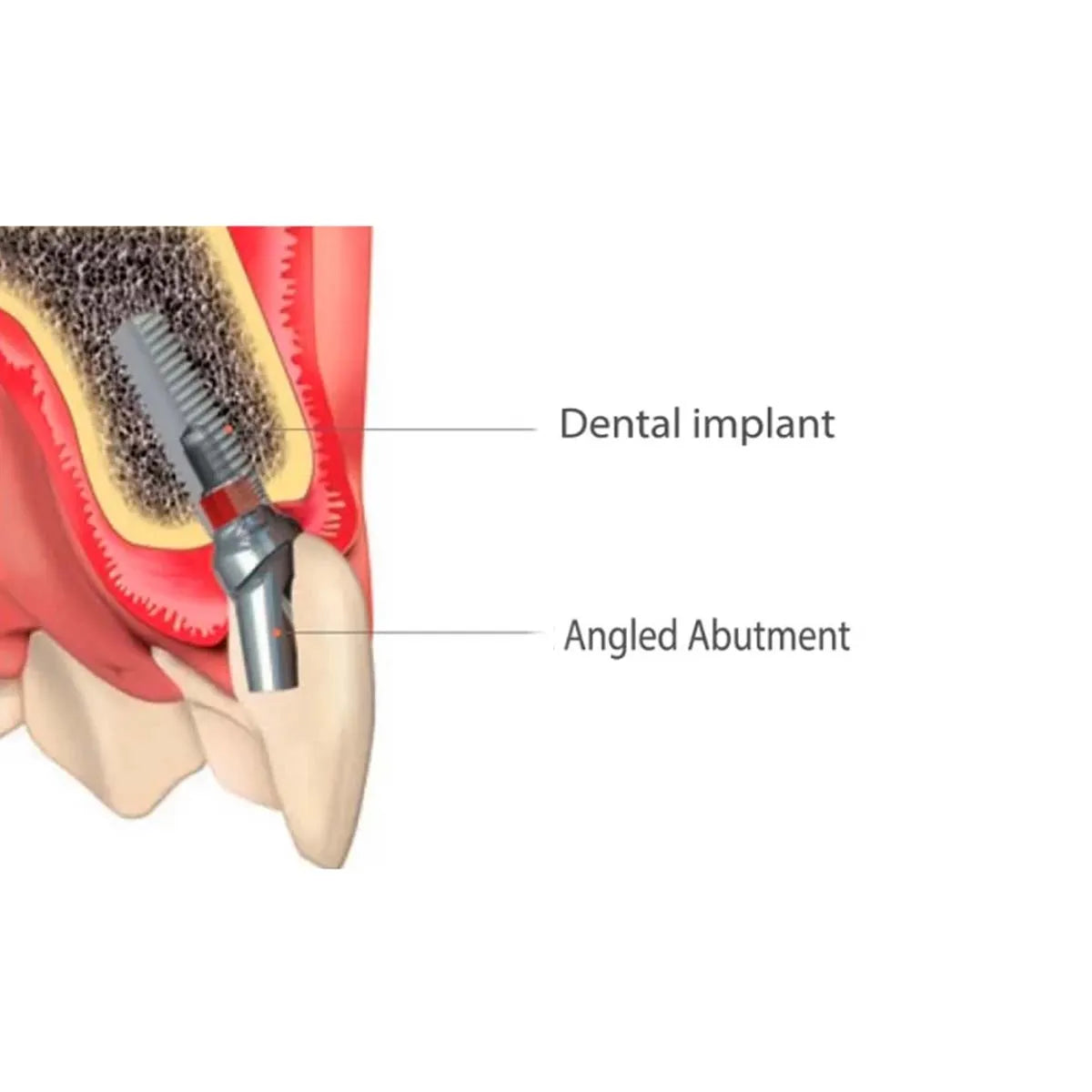 Xcem Dental Implant Angled Abutment 4.5mm - Non Hex