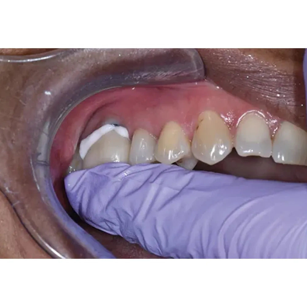 3m Espe Relyx Temp Non Eugenol