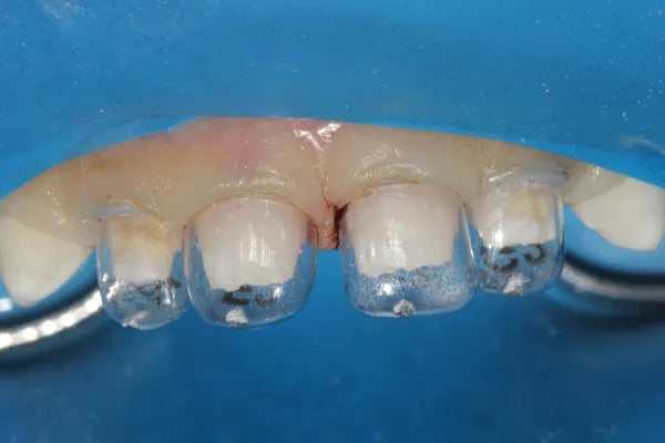 3m Espe Pediatric Strip Crown Forms