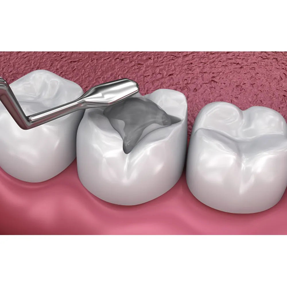 GDC Plastic Filling Instrument - 1 (PLGH3)