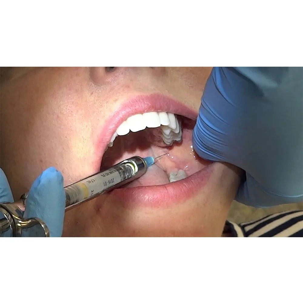 GDC Dental Syringe Non Aspirating With Ring (1.8ml) (SYR1.8)