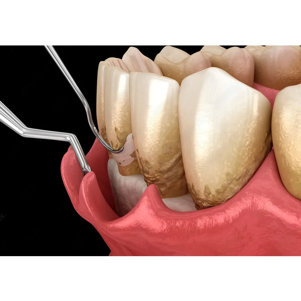 GDC Gracey Curettes Cc Anterior Incisors And Premolars # 7 (Sgcc3/4)