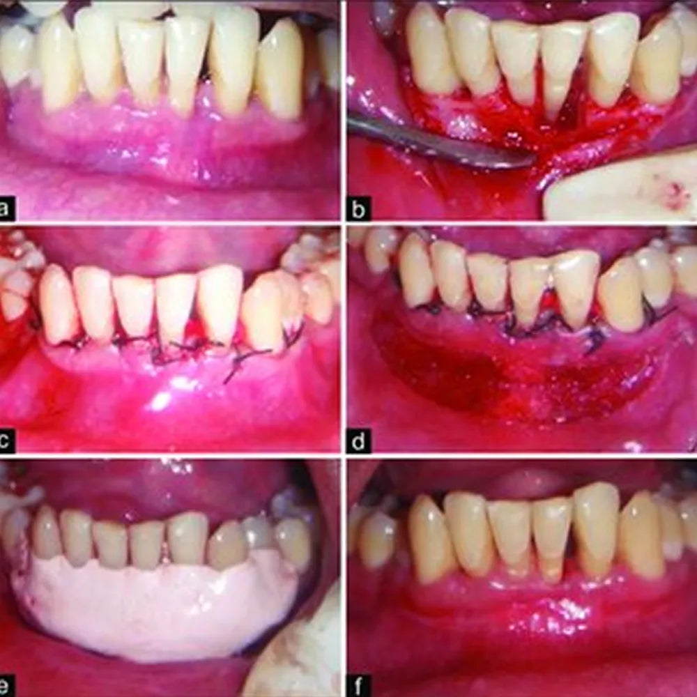 GDC Periosteal Elevator P8d - 6