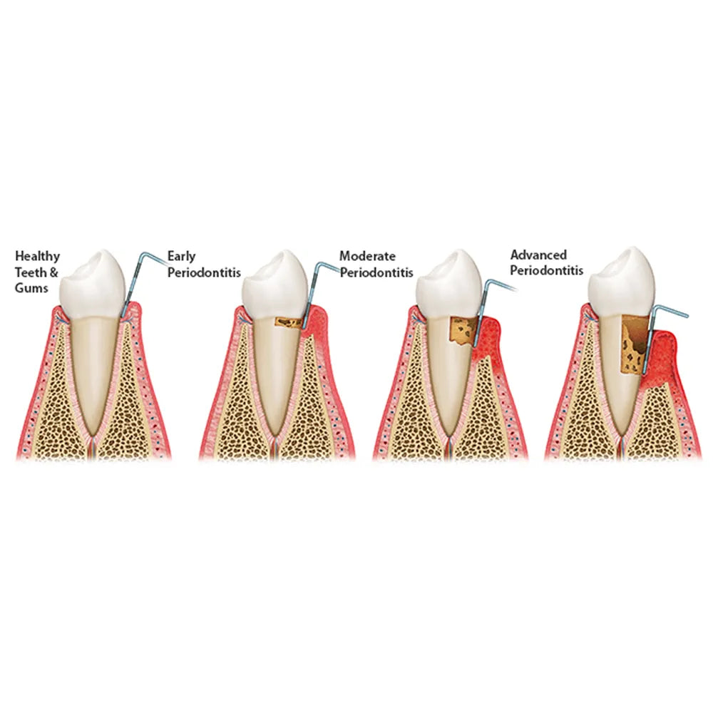 GDC Double End Probes Unc 15 / Screening Probe #6 (PCP15/11.5)
