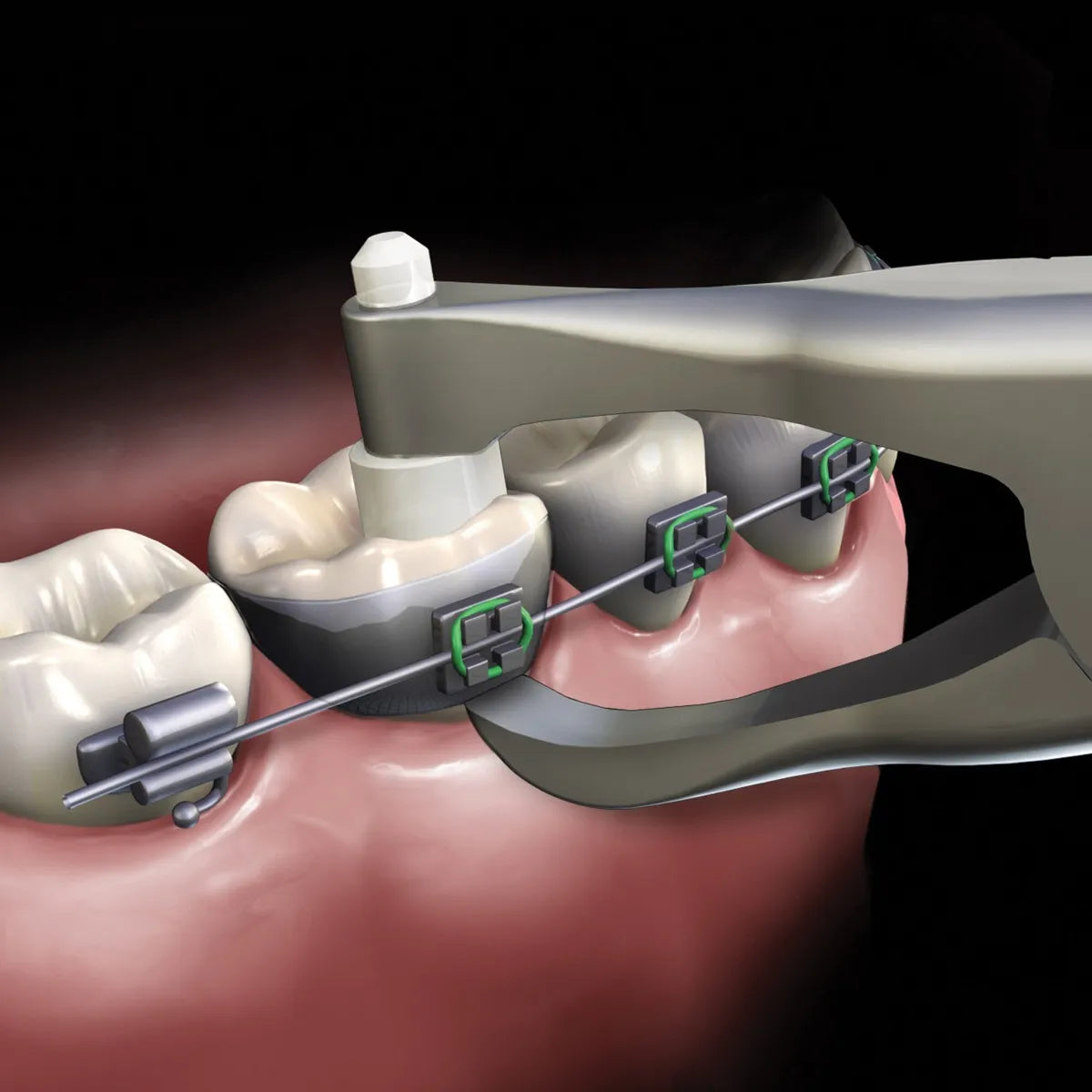 Gdc Posterior Band Remover