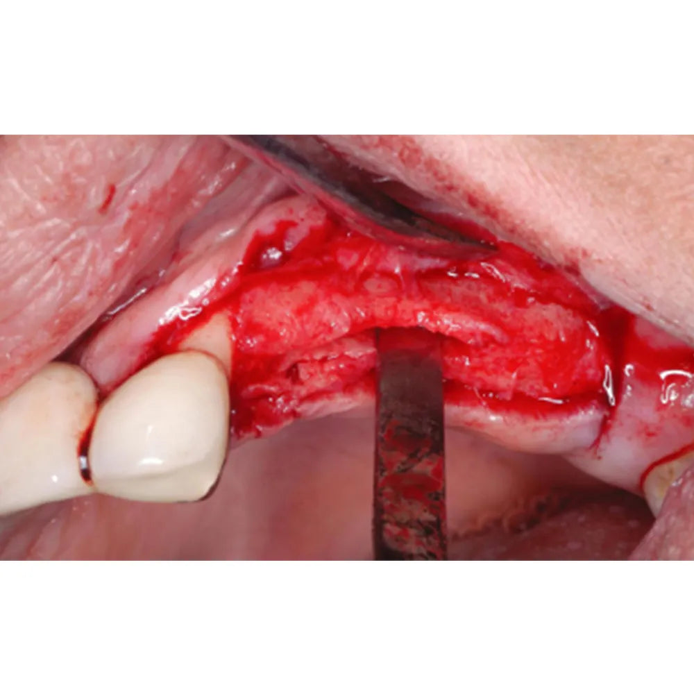 GDC Bone Chisel And Mallet