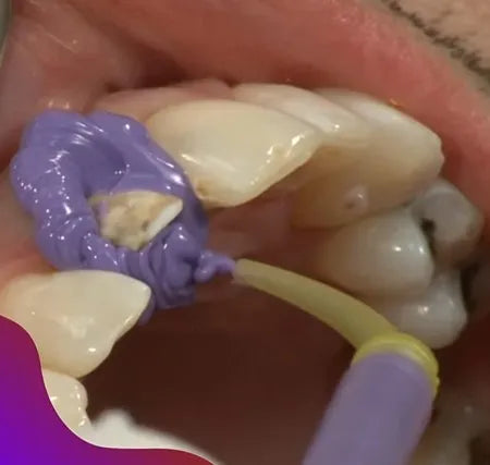 ET Dental Intra Oral Tips