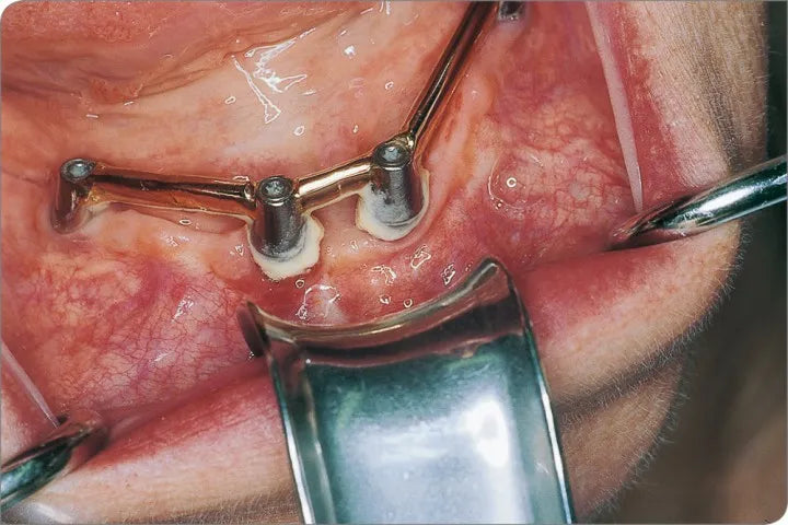 API Metallic Cheek Retractor