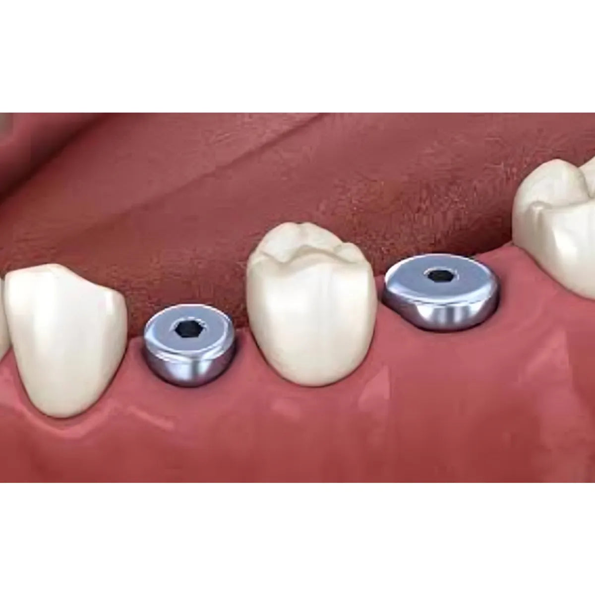 Adin Closefit RP Healing Abutment