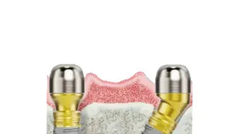 Adin CloseFit NP Angled TMA Abutment