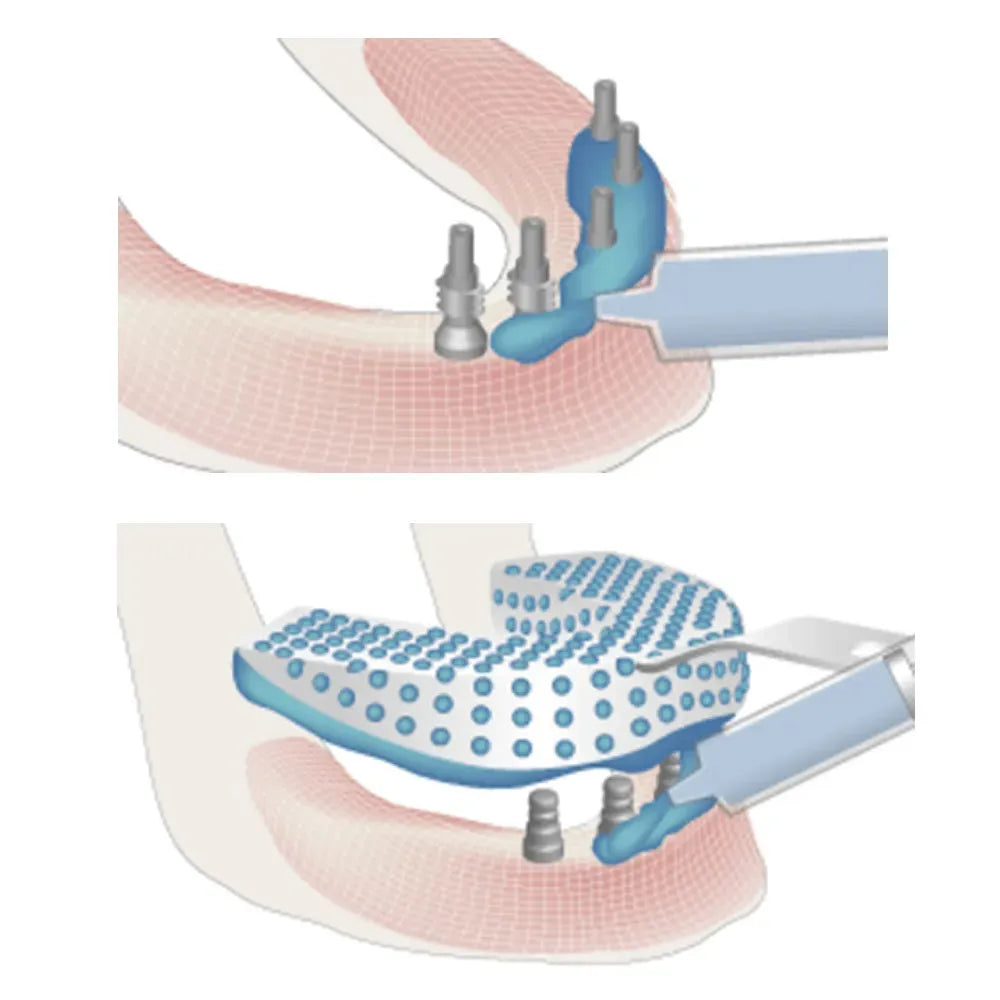 Adin TMA Close Tray Impression Coping (RS5011)