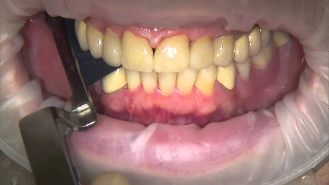 Bausch Arti Fol Forceps Straight - BK 132