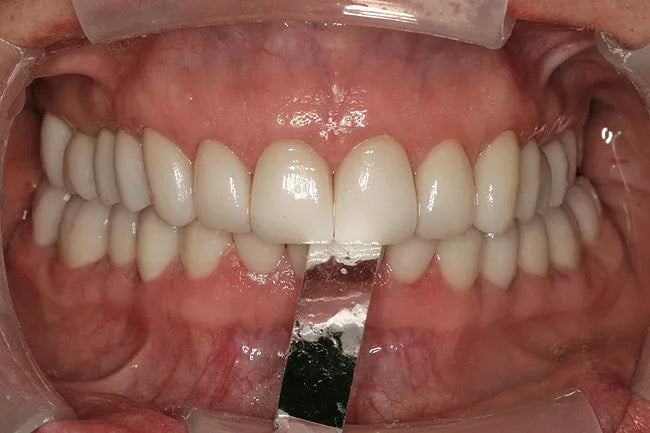 Bausch Arti Fol Metallic Shimstock Flim 12µ Microns