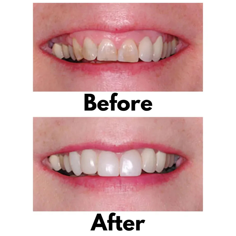 Bioclear 360° Veneer Matrices Pack of 12