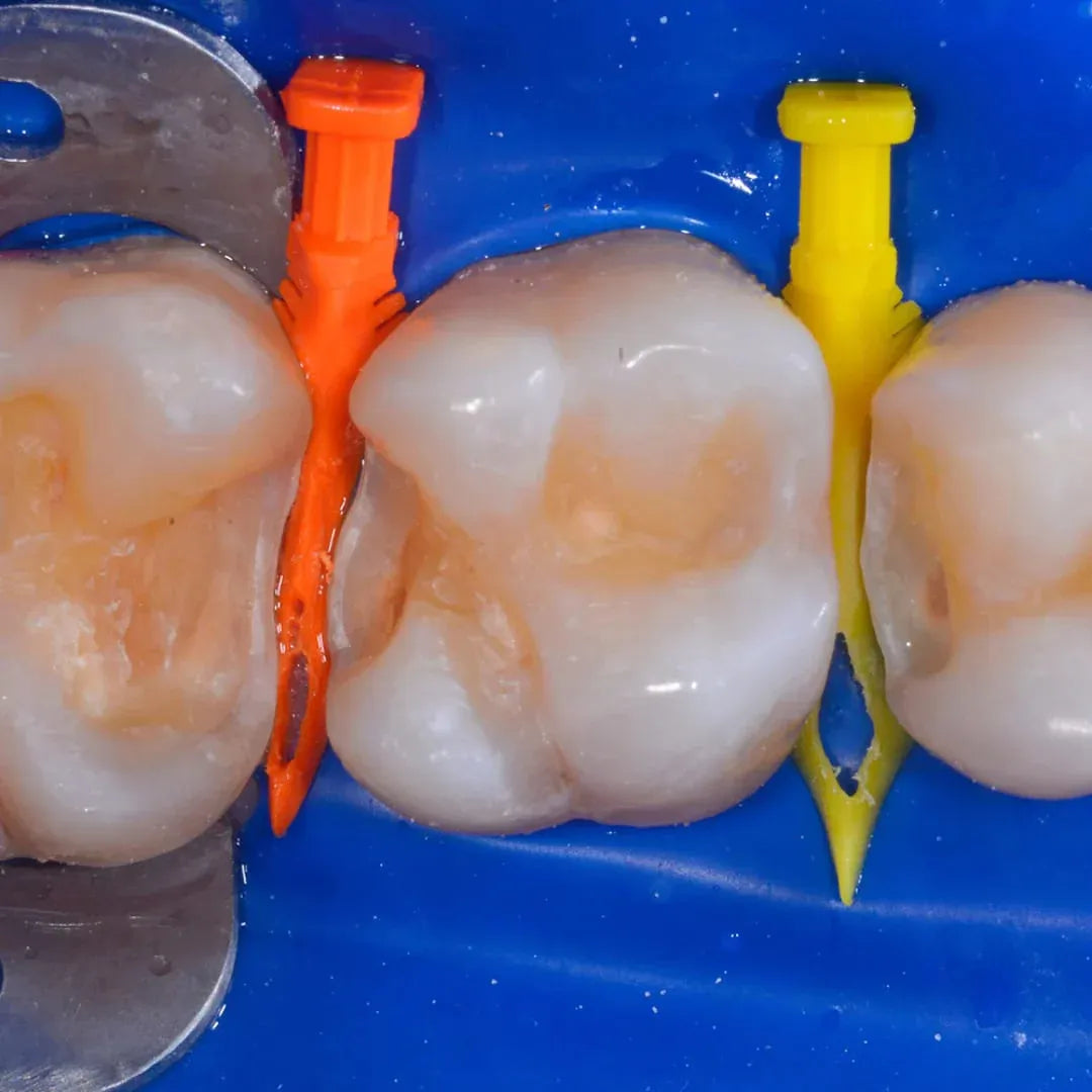 Bioclear Biofit HD Posterior Matrix System Kit