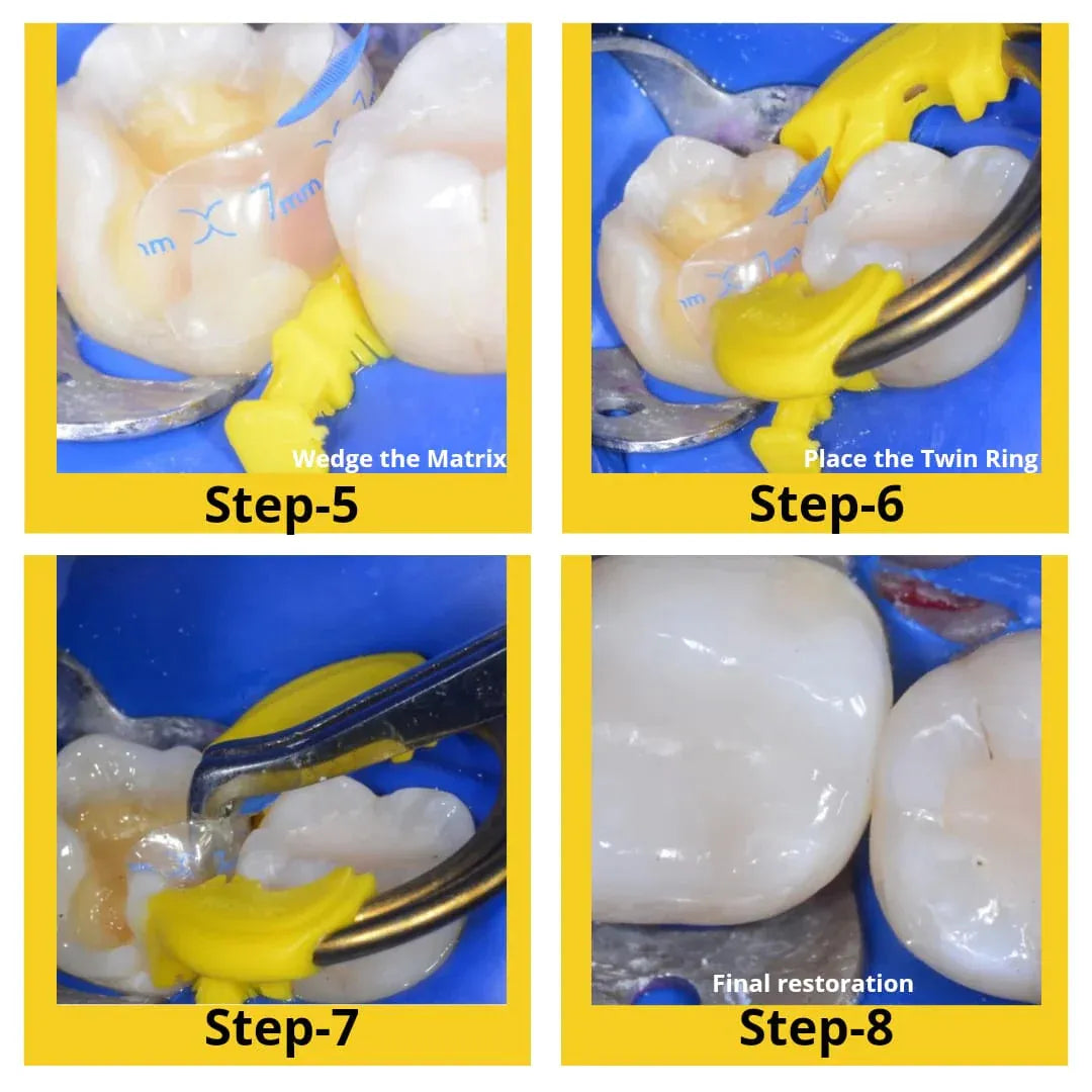 Bioclear Evolve Posterior Matrix Series