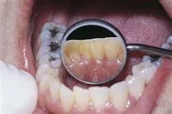 GI Dental Mouth Mirror With Handle (Pack Of 10)