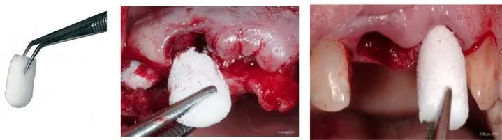 Cologenesis ColoPlug Sterile Collagen Sponge - Pack of 1