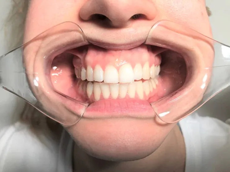 ET Dental Cheek Retractor Y Type (premium)
