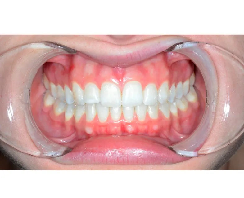 ET Dental Double Sided Cheek Retractor