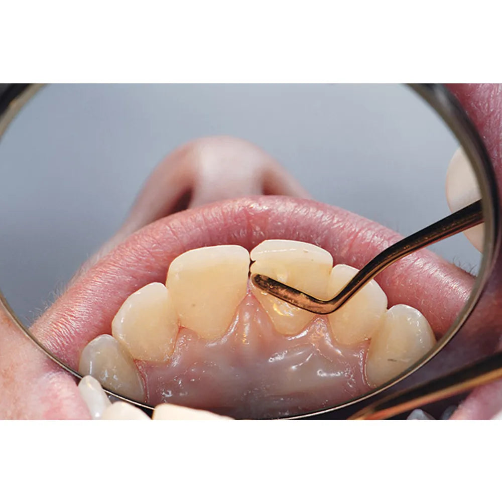 GDC Composite Instrument Flexi Thin Gold Titanium -6 (CIGFT3)