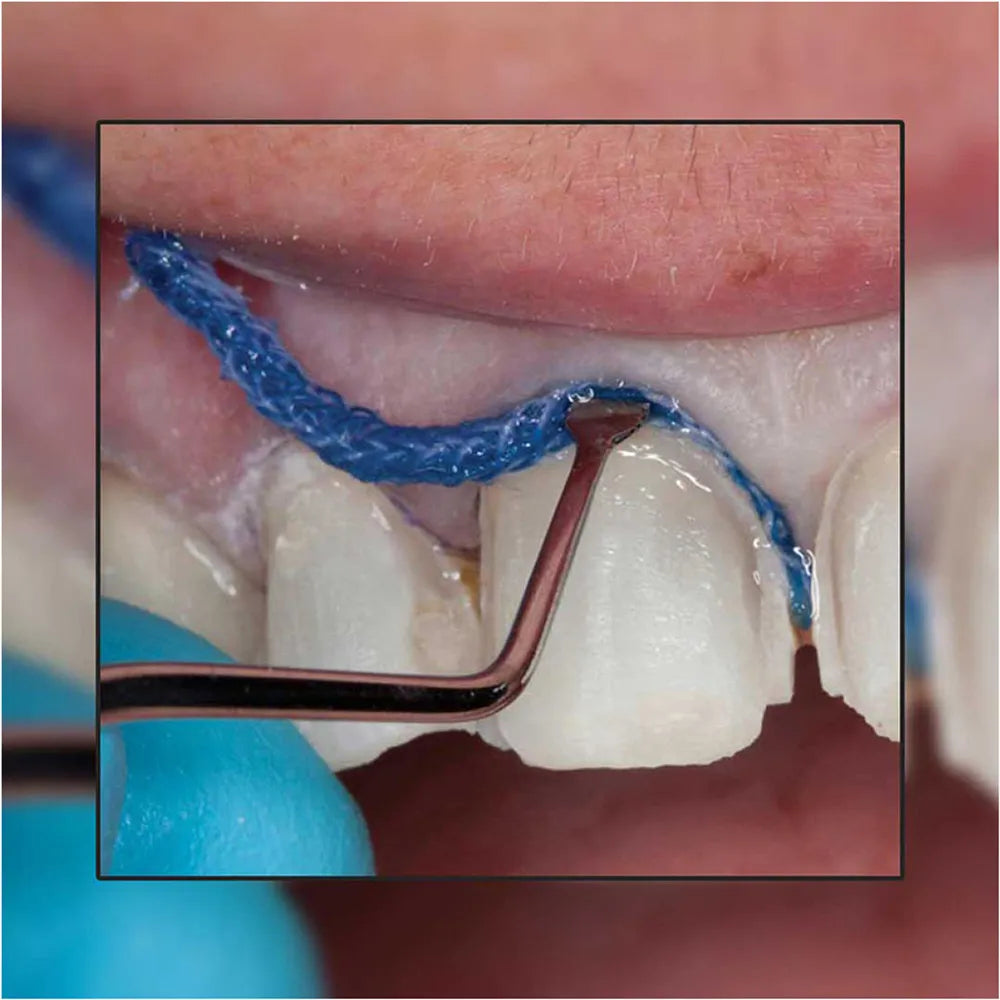 GDC Gingival Cord Packer