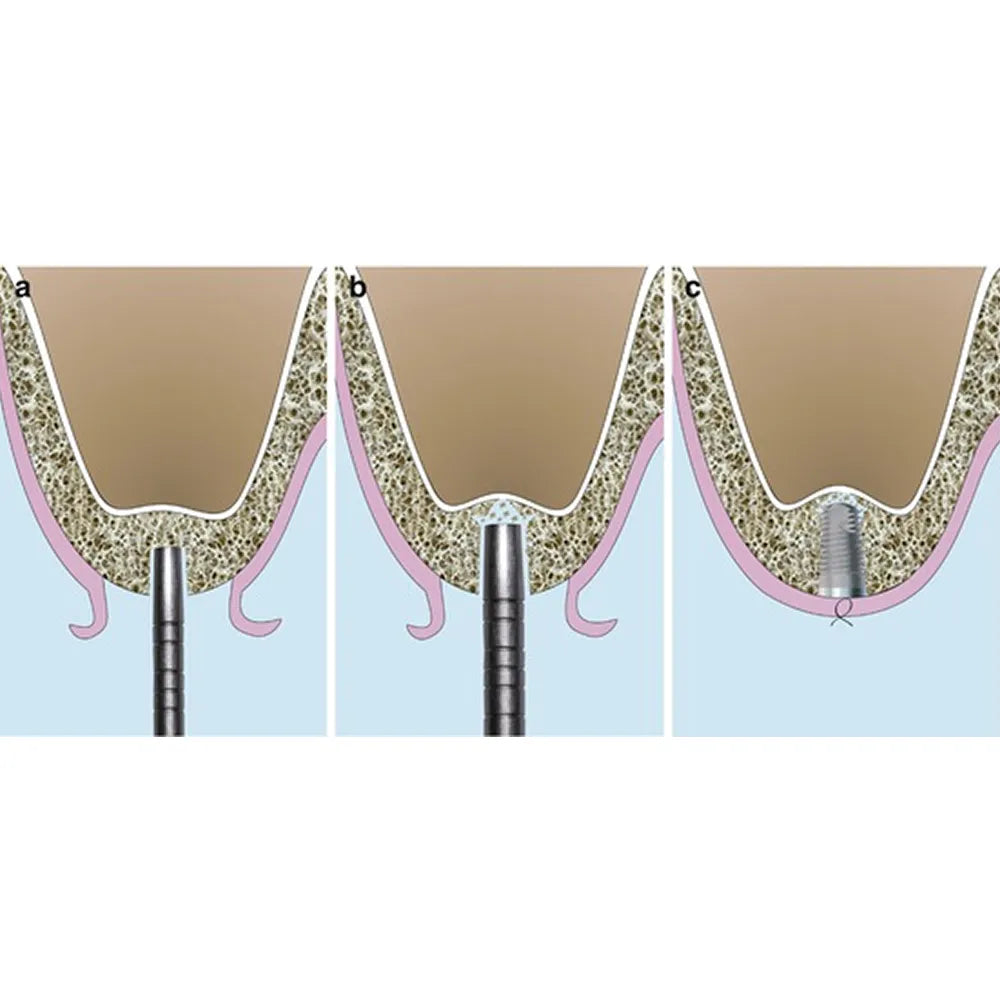 GDC Osteotomes Concave Curved with Cassette Set Of 6 (OSTMSHAWC6)