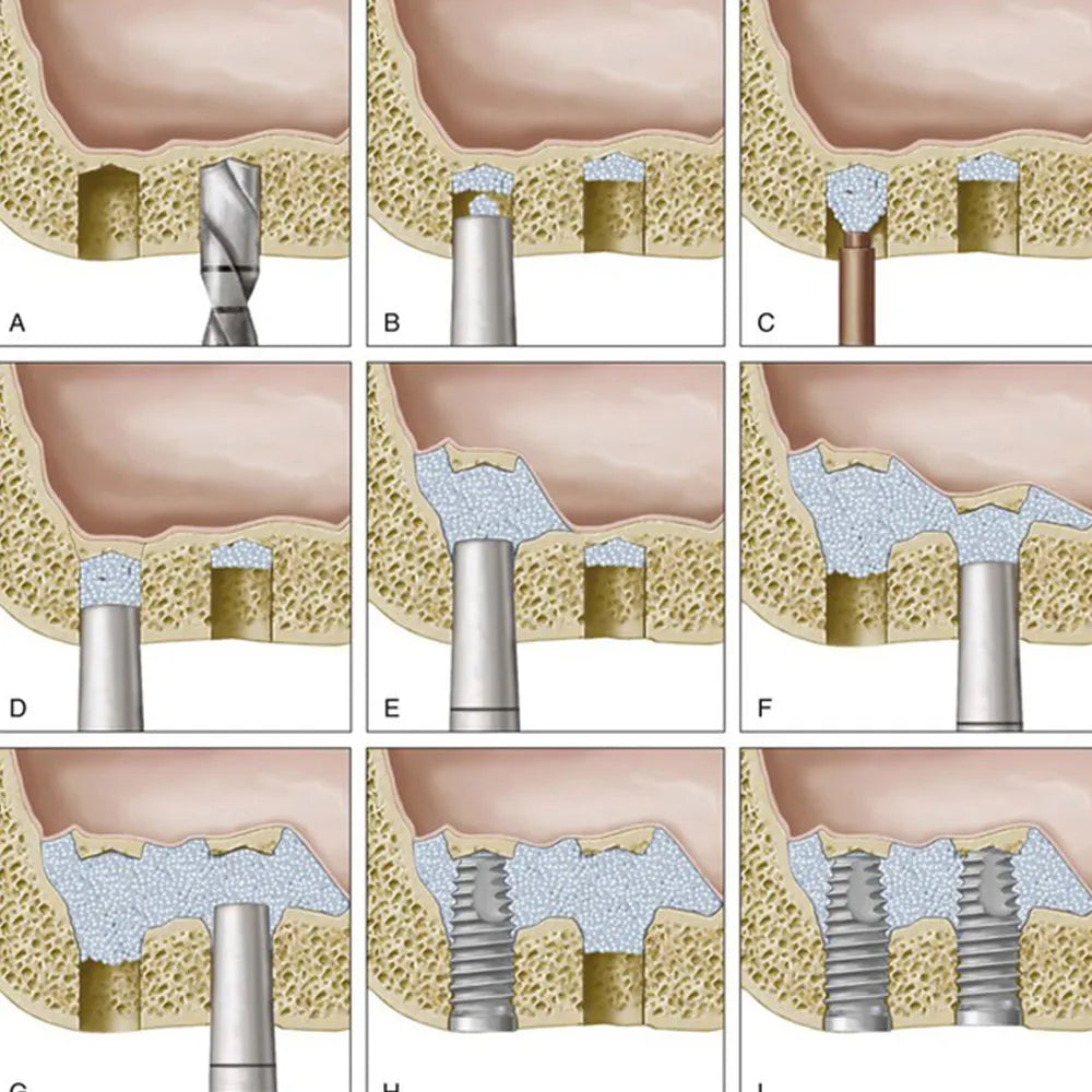 GDC Osteotomes Flat Straight with Cassette Set Of 6 (OSTMPUWC6)