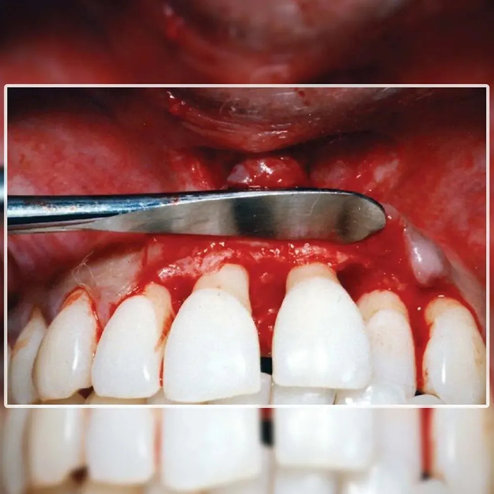 GDC Periosteal Elevator Beal (Beal1)