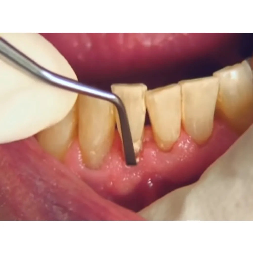 GDC Sickle Scalers Hoe Orban #6 (So8/9)