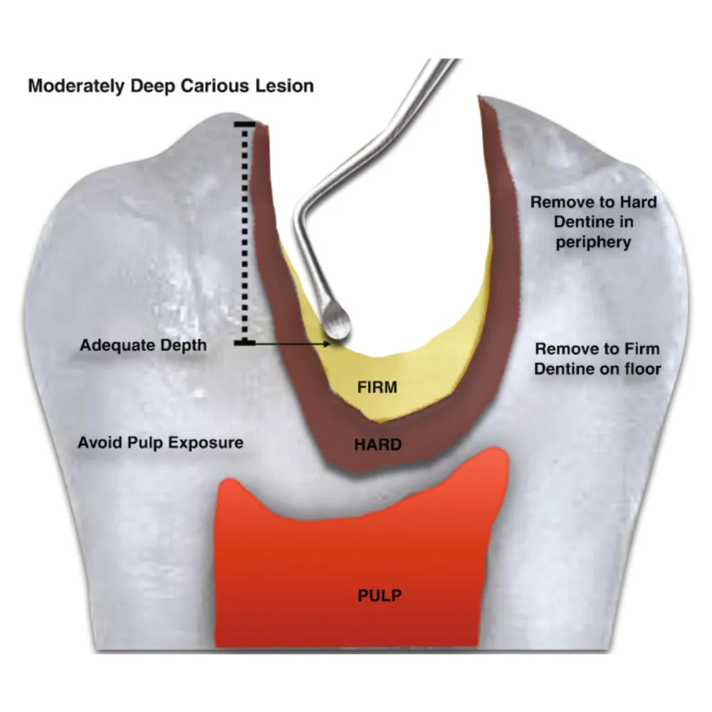 GDC Spoon Excavator -6 (Exc19h)