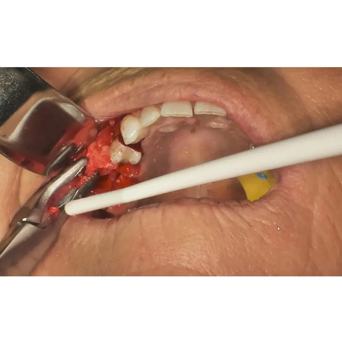 Generic InstrumentsGI Bone Rongeur TC