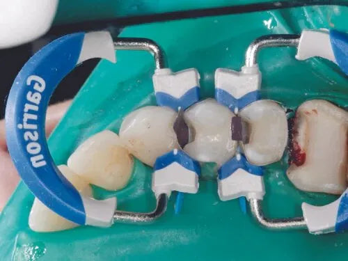 Garrison Dental Composi-Tight 3D Fusion Matrix Rings