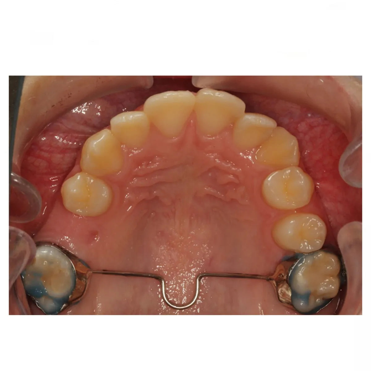 JJ Ortho Palatal Bar With Distal Loop