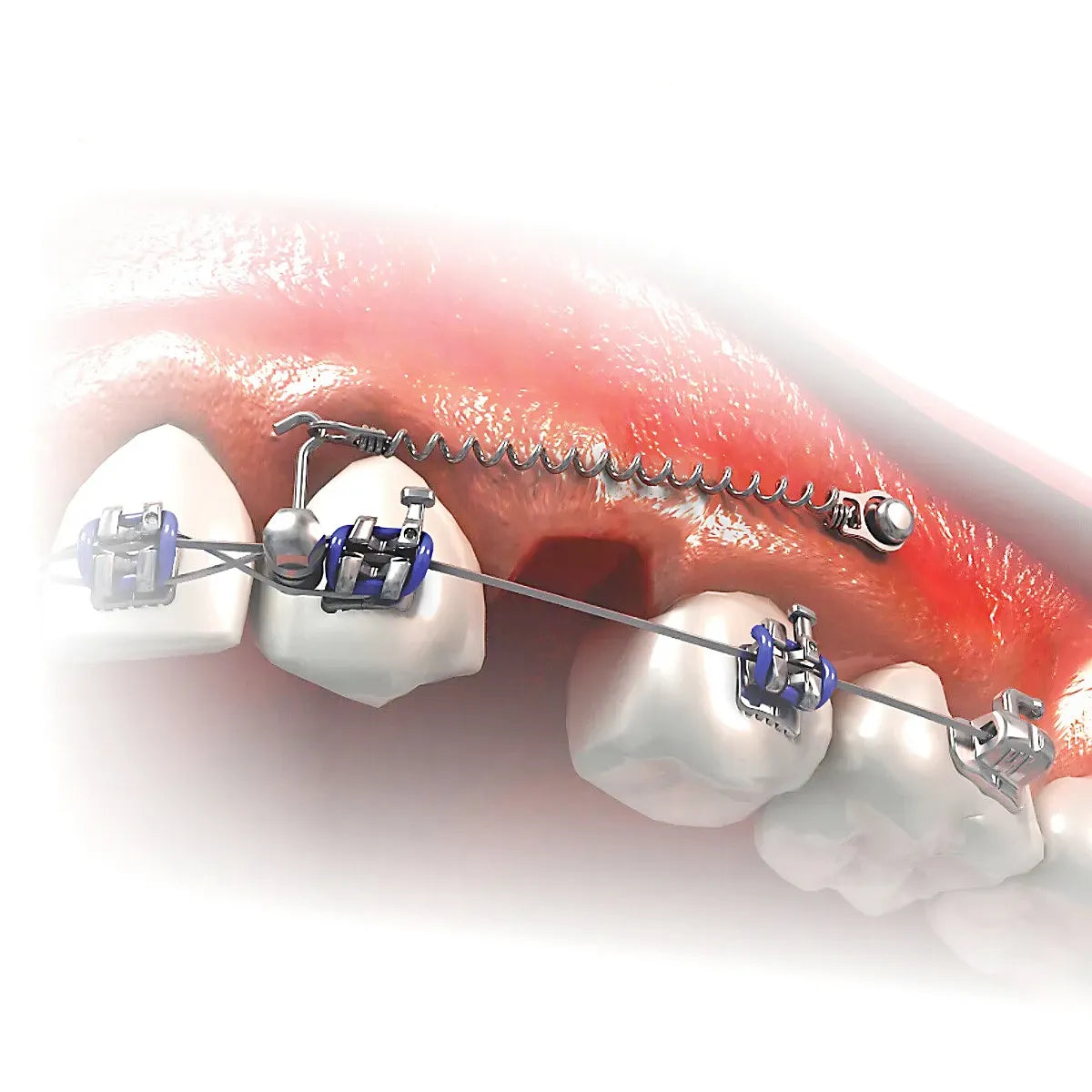 JJ Ortho Buccal Shelf Screw Implants