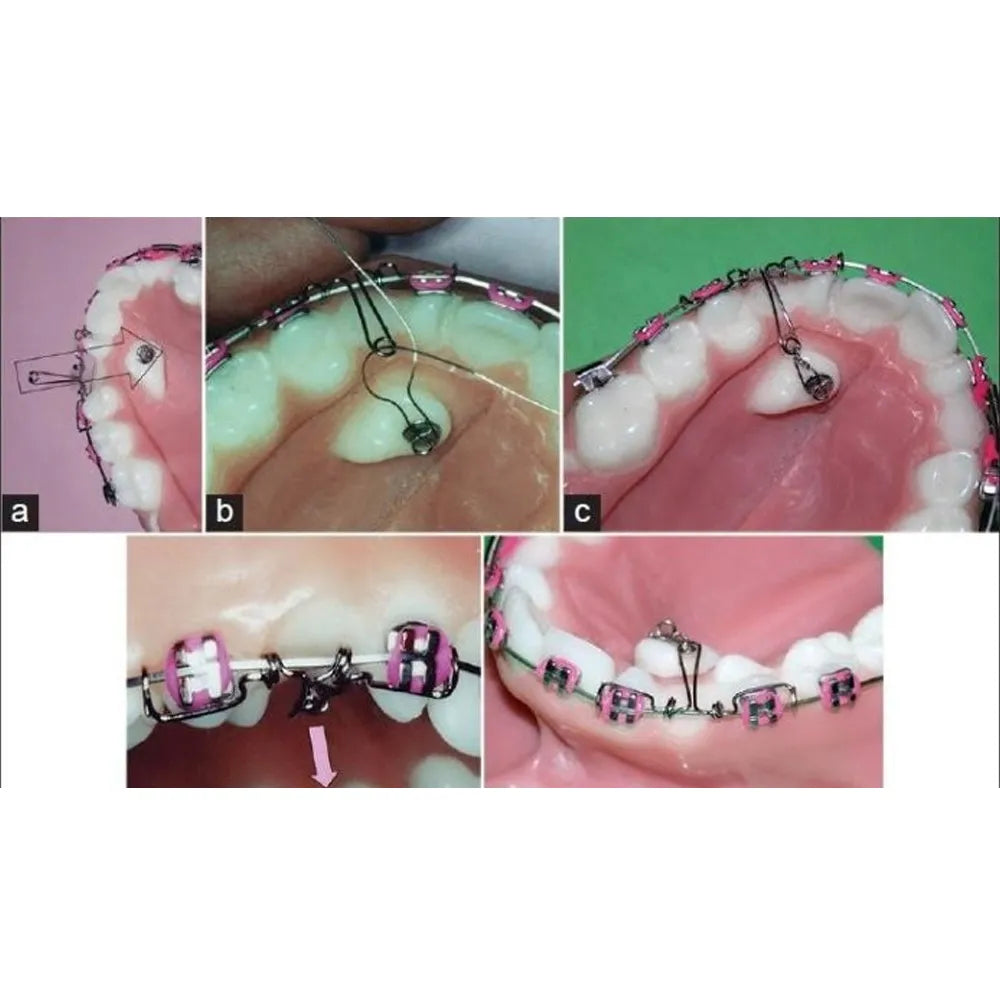 JJ Ortho Hooks For Traction of Non Erupted Teeth (60.01.61)