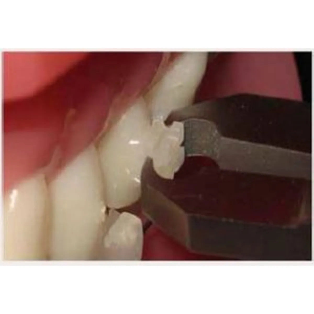 JJ Ortho Illusion Polycrystalline Ceramic Bracket Kits
