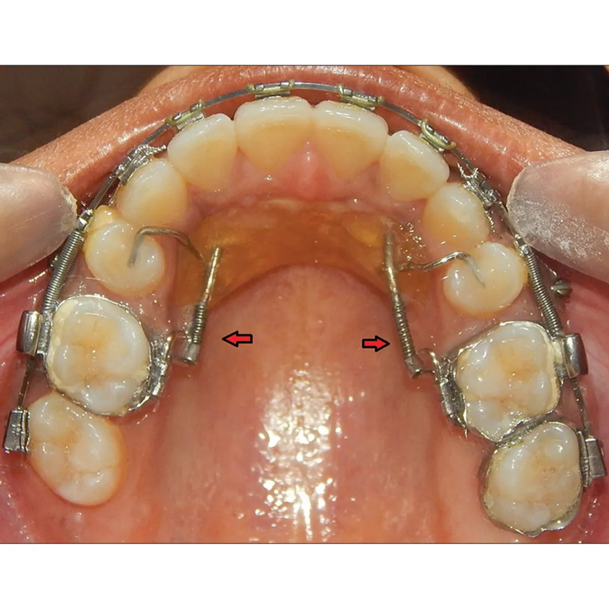 JJ Ortho Molar Distalizing Spring (60.01.77)