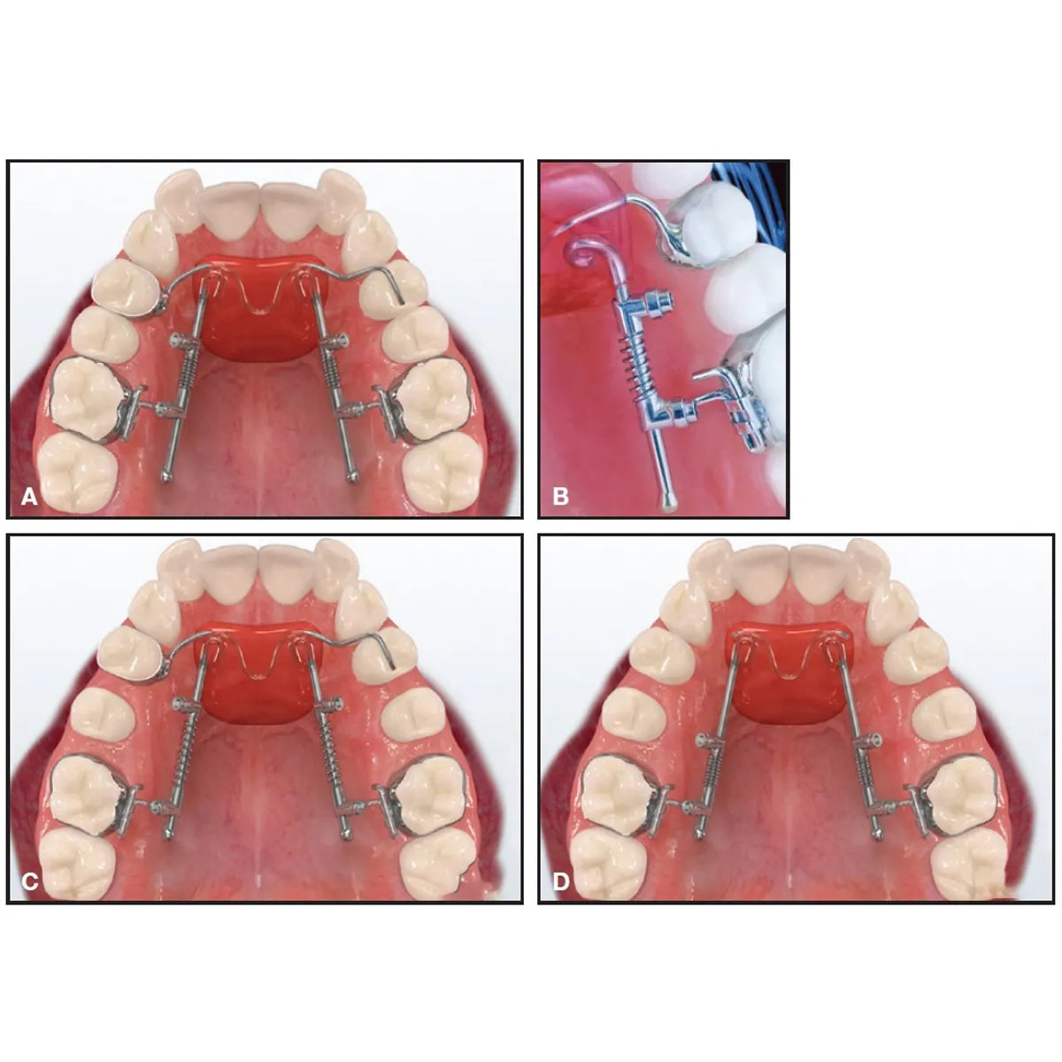 JJ Ortho Molar Distalizing Spring (60.01.77)